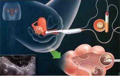 辟谣：试管取卵过程真的有那么恐怖么？需要麻醉么？