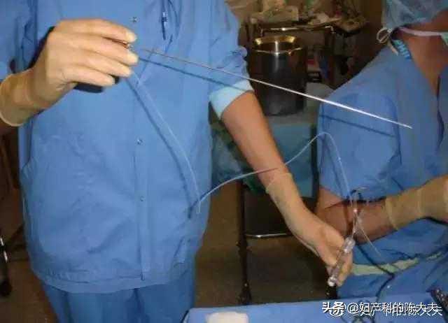 论女性试管风险有多大，恰似那近半米长的取卵针