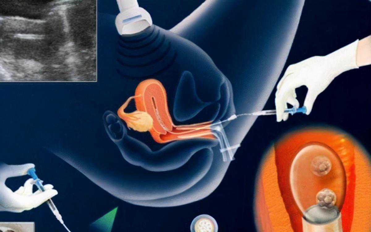 试管婴儿过程中，促排药物用国产的好还是用进口的好？