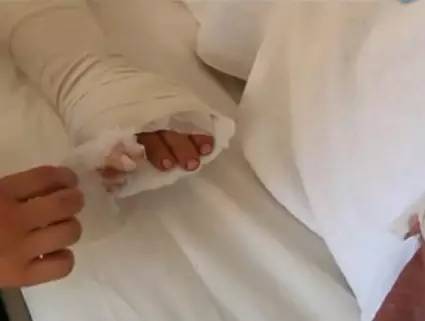 怀孕5个月的妻子被丈夫用菜刀砍断手指｜疑因"试管婴儿"起矛盾