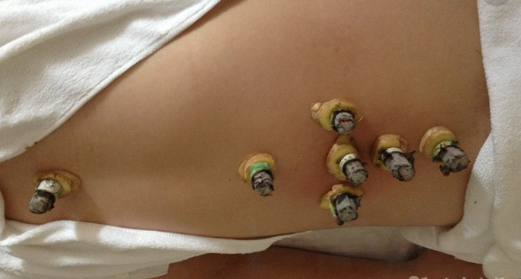 多囊、巧囊伴有体寒和月经不调的我分享好孕经验