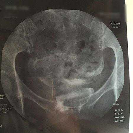 试管婴儿并不是不孕不育夫妇的最后一根稻草