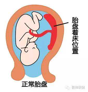 孕期出血：是流产先兆？孩子还能保住吗？